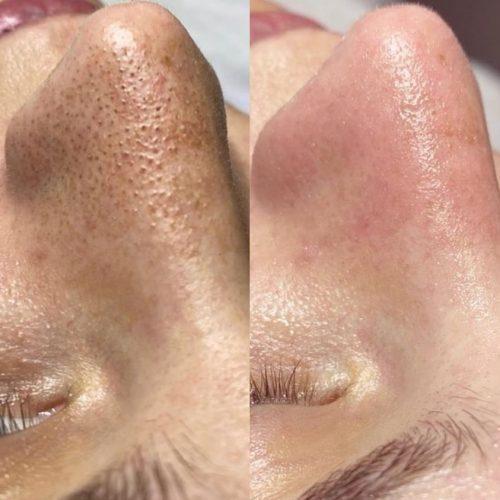 Hydrafacial Results