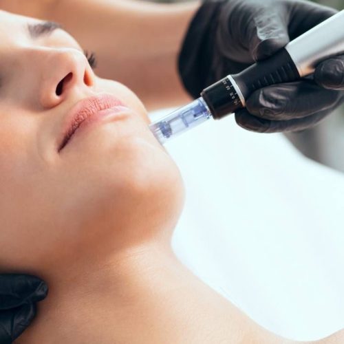 Microneedling
